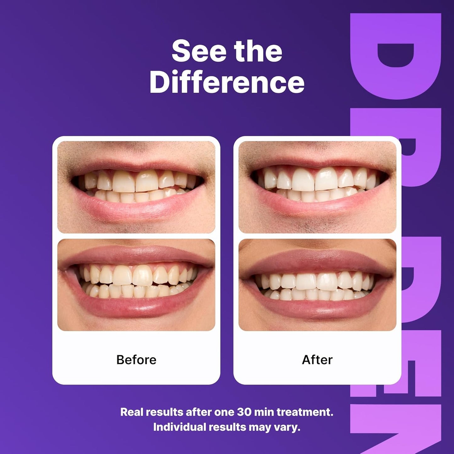 Gentle Teeth Whitening That Actually Works
